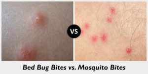 Bed Bug Bites Vs Mosquito Bites