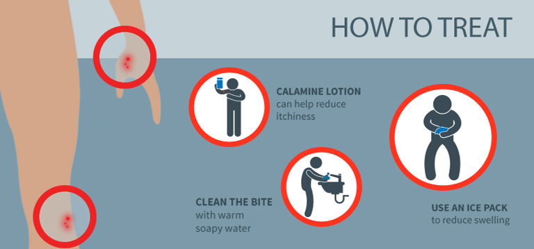 Treating Bed Bug Bites